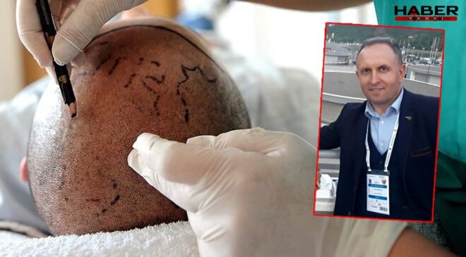 Saç ekimi sonu oldu