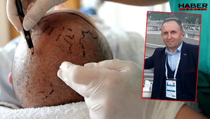 Saç ekimi sonu oldu